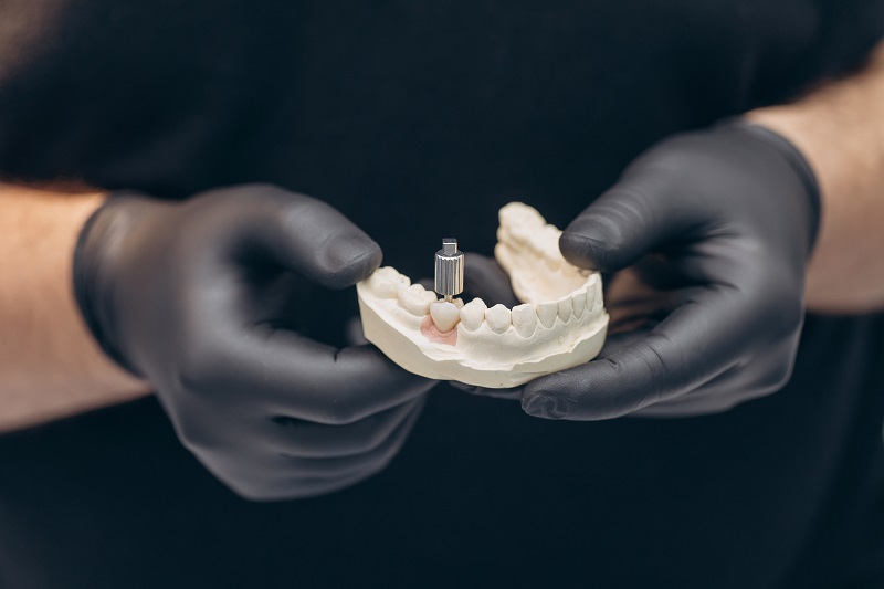 Benefits of Crowns and Bridges