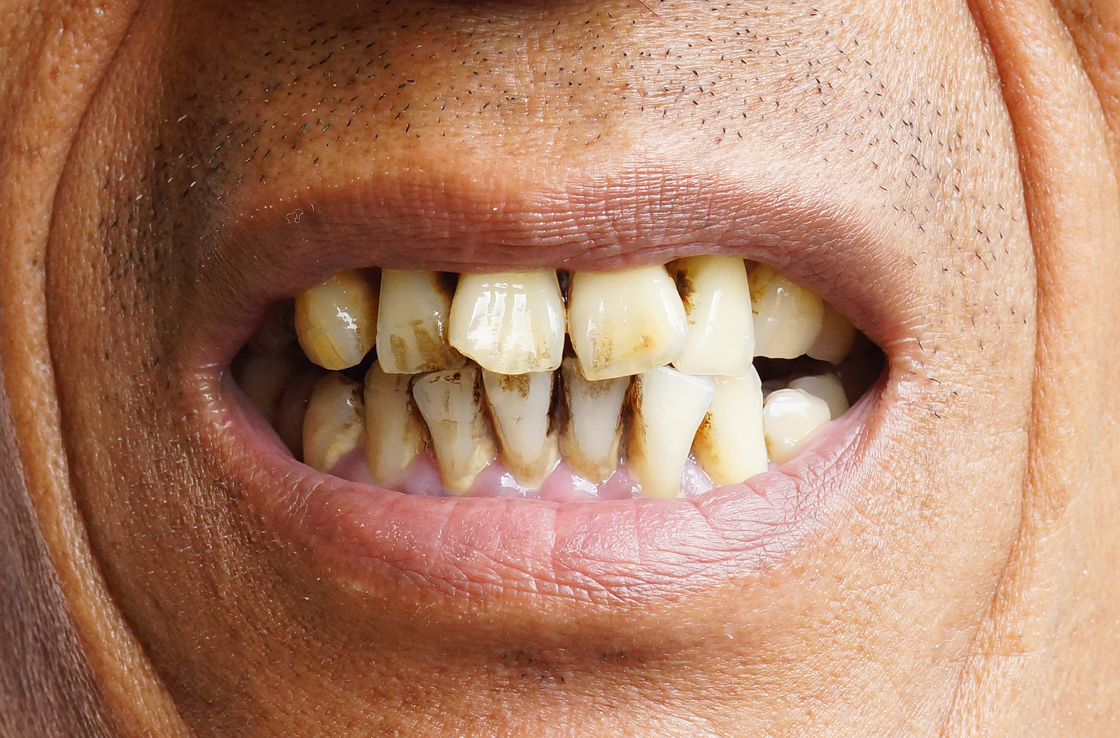 Top Four Destructive Oral Habits That Damage Teeth